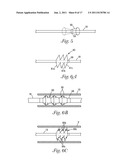 CATHETER WITH OCCLUDING CUFF diagram and image