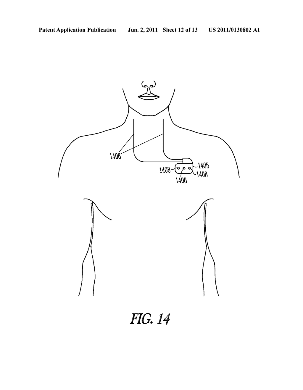 SYSTEM AND METHOD FOR TESTING NEURAL STIMULATION THRESHOLD - diagram, schematic, and image 13