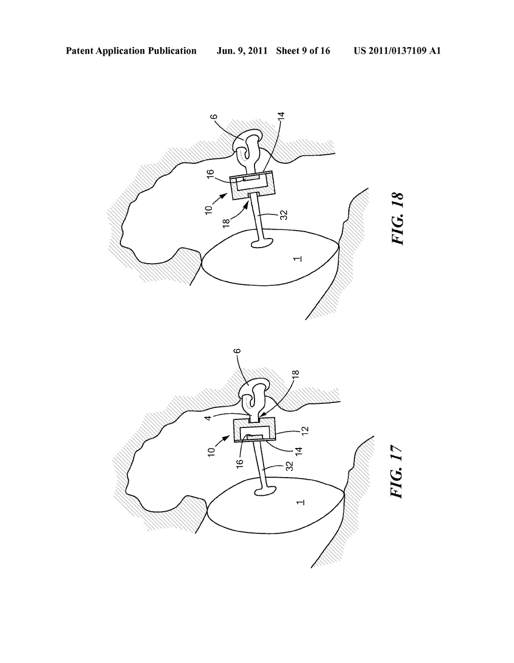 IMPLANTABLE MICROPHONE FOR HEARING SYSTEMS - diagram, schematic, and image 10