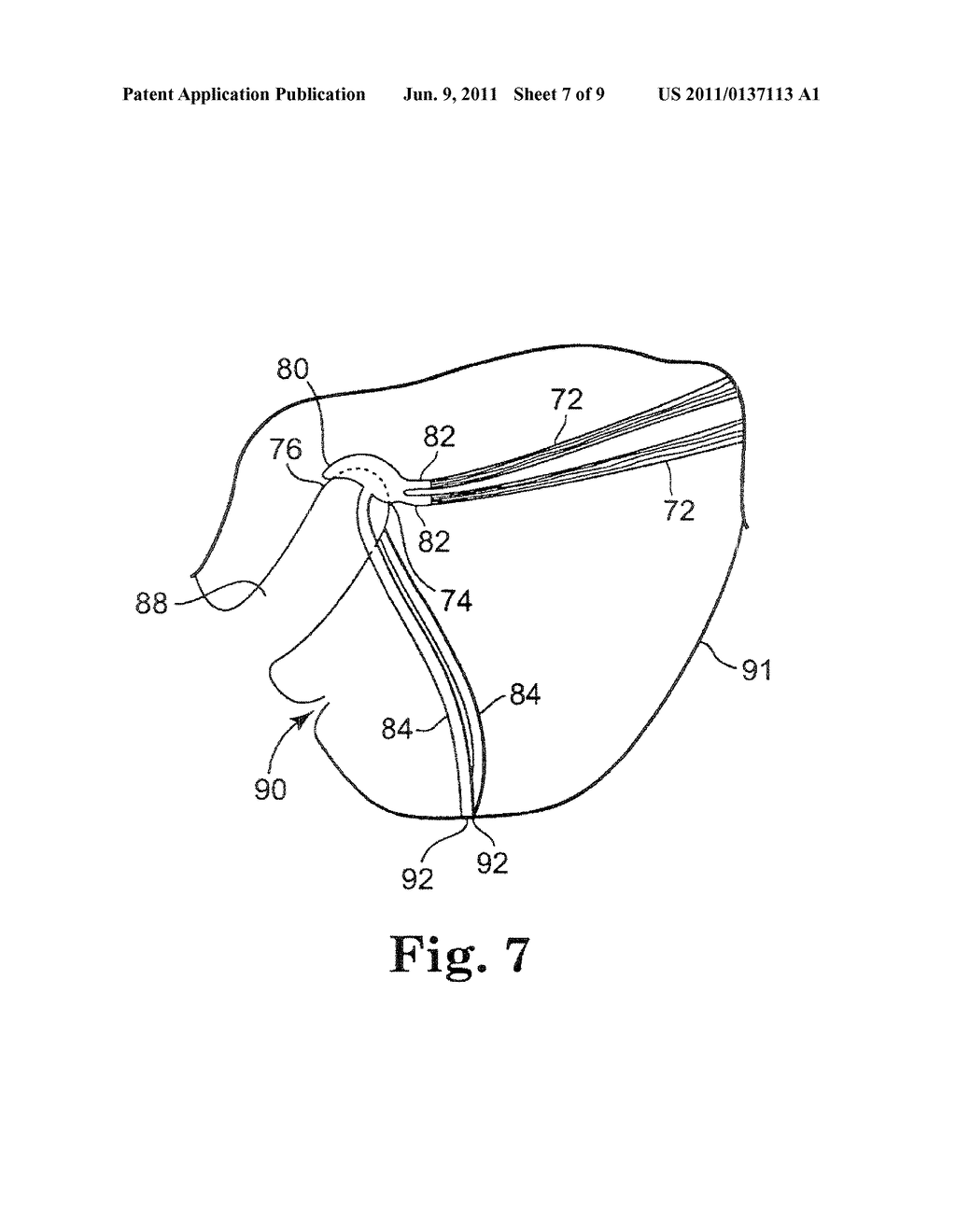 Method for Supporting Vaginal Cuff - diagram, schematic, and image 08