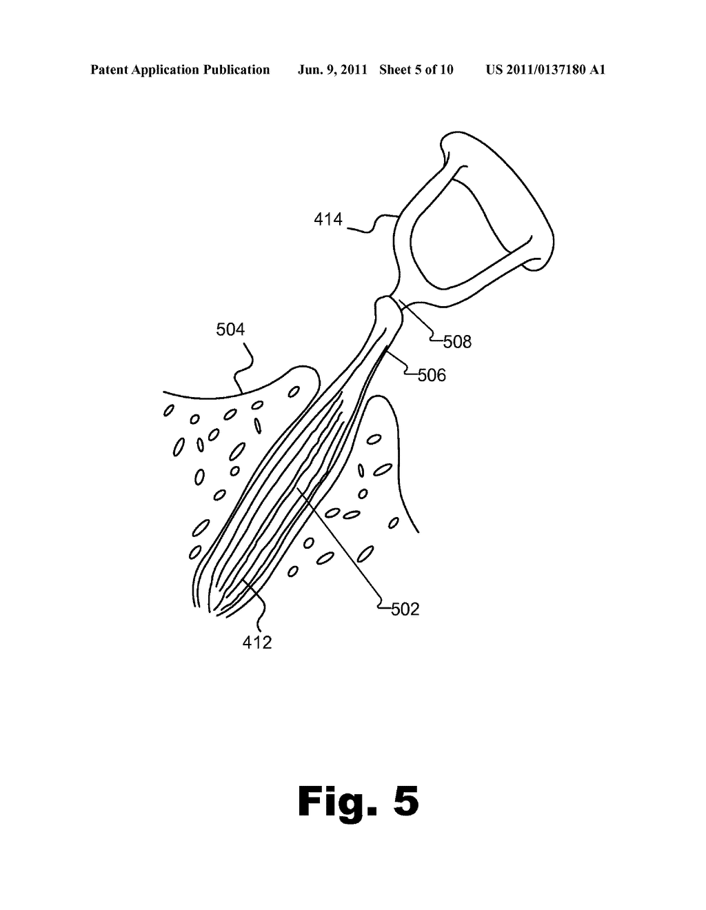 Systems and Methods for Fitting a Cochlear Implant System to a Patient     Based on Stapedius Displacement - diagram, schematic, and image 06