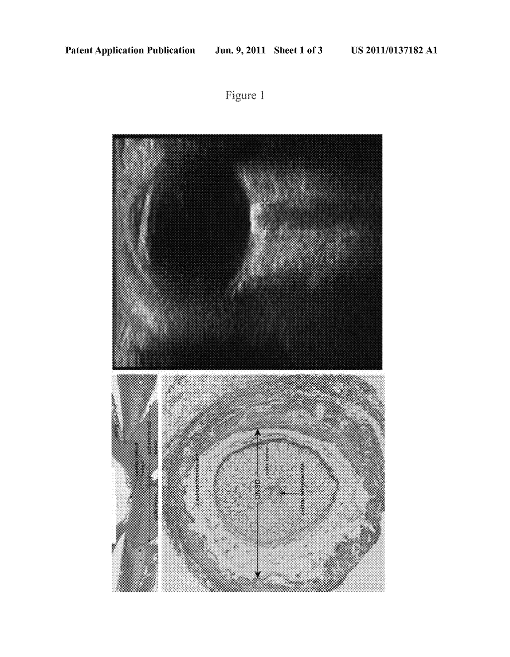 METHODS AND DEVICES FOR ASSESSING INTRACRANIAL PRESSURE - diagram, schematic, and image 02