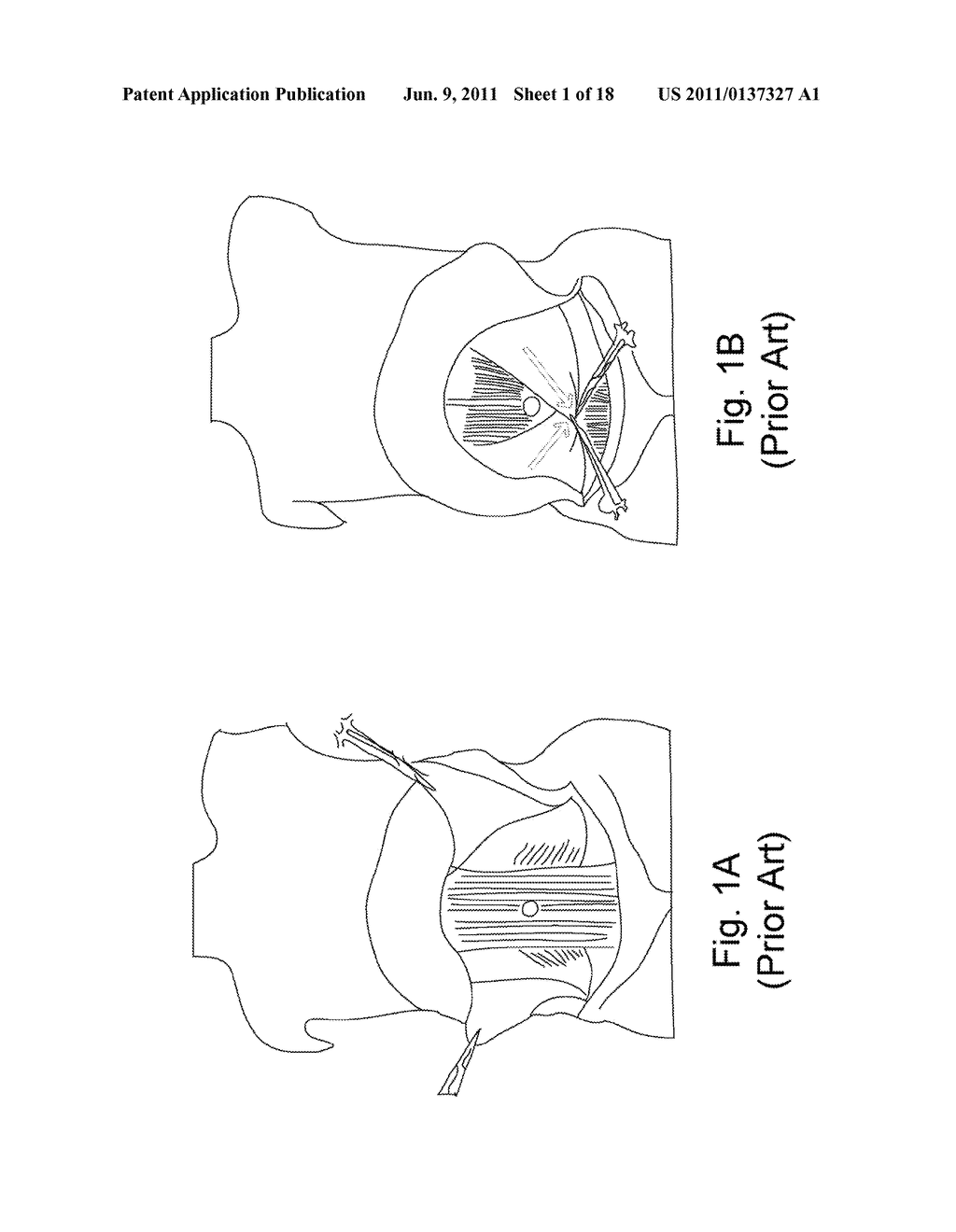 SUBCUTANEOUS WAIST BAND AND METHODS RELATED THERETO - diagram, schematic, and image 02