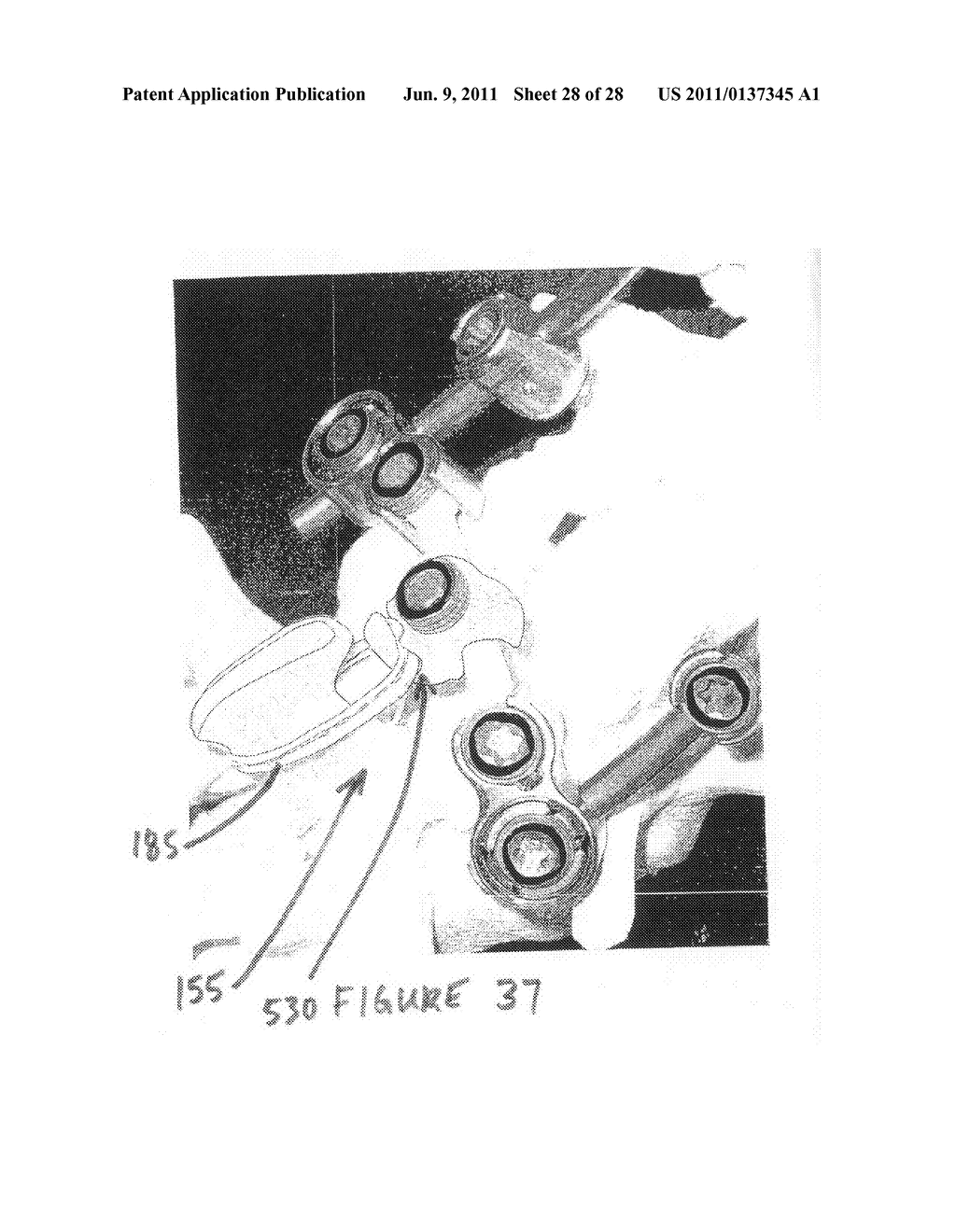 Posterior lumbar fusion - diagram, schematic, and image 29
