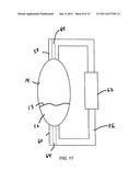 BONE COMPRESSION DEVICE AND METHODS diagram and image