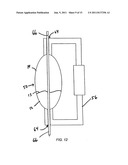 BONE COMPRESSION DEVICE AND METHODS diagram and image