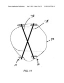 BONE COMPRESSION DEVICE AND METHODS diagram and image