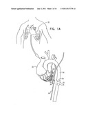 THORACIC AORTA AND VAGUS NERVE STIMULATION diagram and image