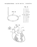 THORACIC AORTA AND VAGUS NERVE STIMULATION diagram and image