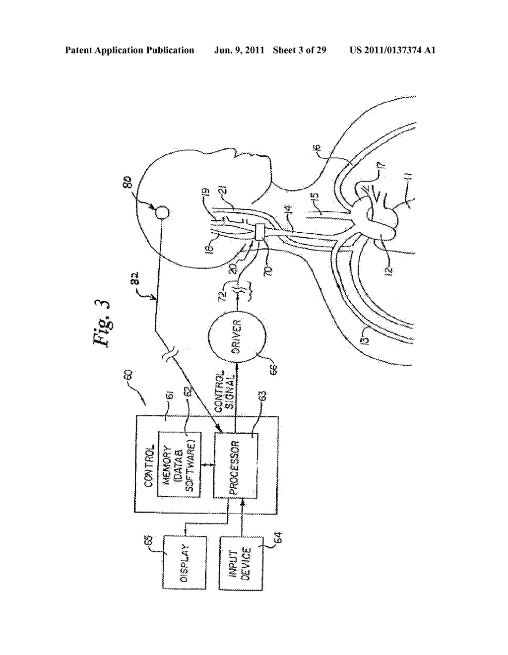 DEVICES AND METHODS FOR ELECTRODE IMPLANTATION - diagram, schematic, and image 04