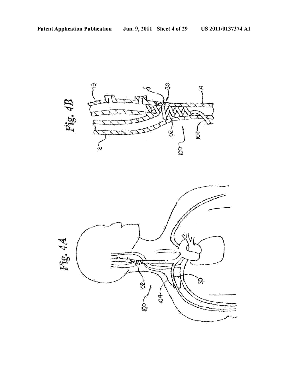 DEVICES AND METHODS FOR ELECTRODE IMPLANTATION - diagram, schematic, and image 05