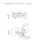 DEVICES AND METHODS FOR ELECTRODE IMPLANTATION diagram and image