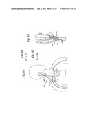 DEVICES AND METHODS FOR ELECTRODE IMPLANTATION diagram and image