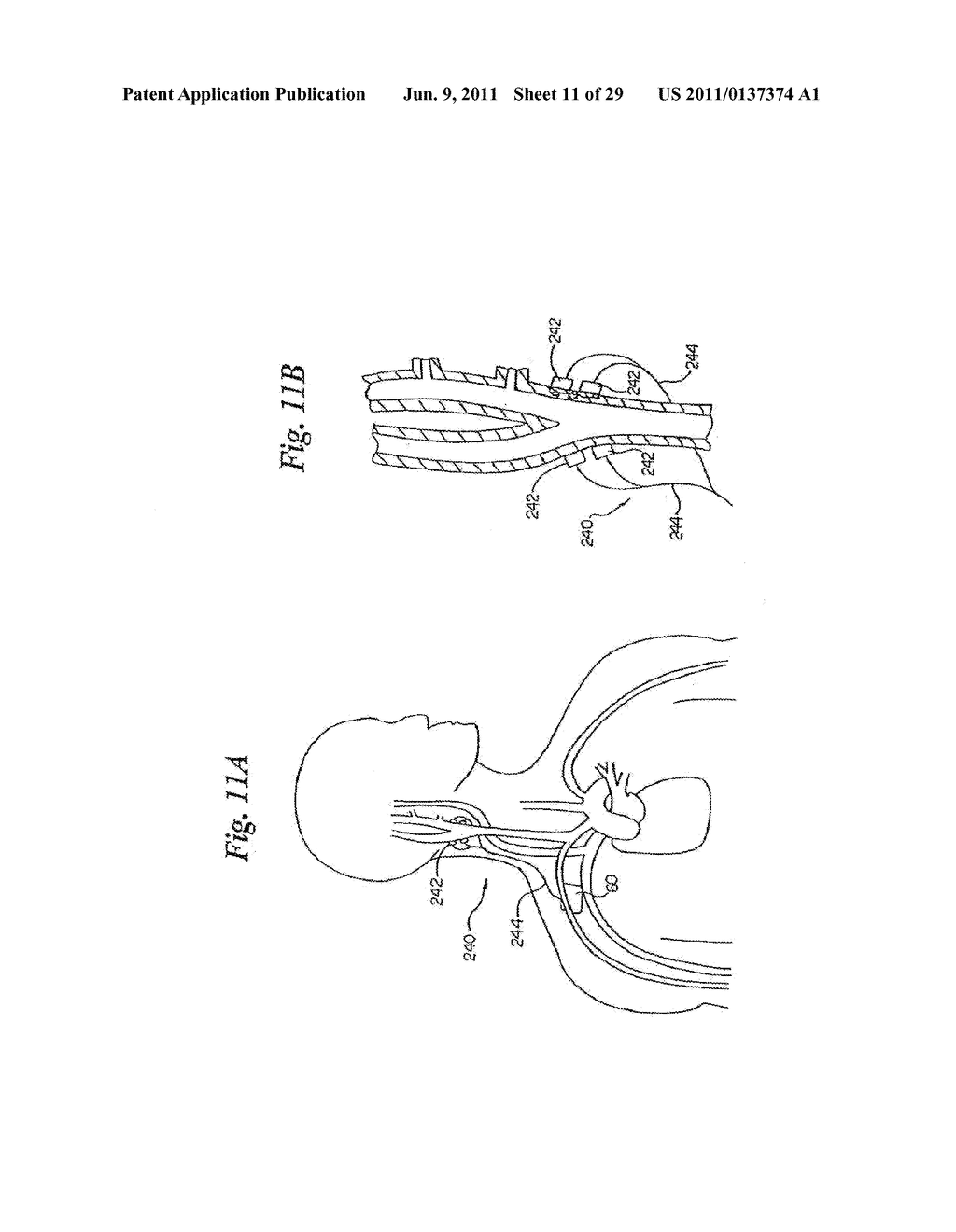DEVICES AND METHODS FOR ELECTRODE IMPLANTATION - diagram, schematic, and image 12