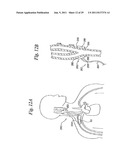 DEVICES AND METHODS FOR ELECTRODE IMPLANTATION diagram and image