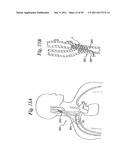 DEVICES AND METHODS FOR ELECTRODE IMPLANTATION diagram and image