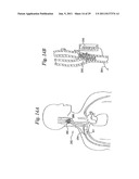 DEVICES AND METHODS FOR ELECTRODE IMPLANTATION diagram and image