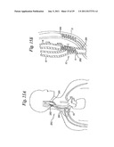 DEVICES AND METHODS FOR ELECTRODE IMPLANTATION diagram and image