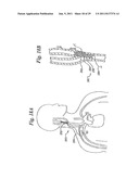 DEVICES AND METHODS FOR ELECTRODE IMPLANTATION diagram and image