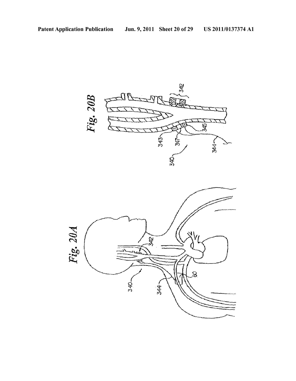 DEVICES AND METHODS FOR ELECTRODE IMPLANTATION - diagram, schematic, and image 21