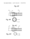 Microvalve Protection Device and Method of Use for Protection Against     Embolization Agent Reflux diagram and image