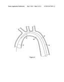 INTRODUCER FOR ENDOVASCULAR IMPLANTS diagram and image