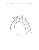 INTRODUCER FOR ENDOVASCULAR IMPLANTS diagram and image