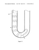 INTRODUCER FOR ENDOVASCULAR IMPLANTS diagram and image