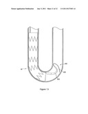 INTRODUCER FOR ENDOVASCULAR IMPLANTS diagram and image