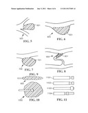 Stent with Expandable Foam diagram and image