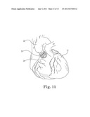 Method and System For Cardiac Valve Delivery diagram and image