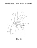 Method and System For Cardiac Valve Delivery diagram and image