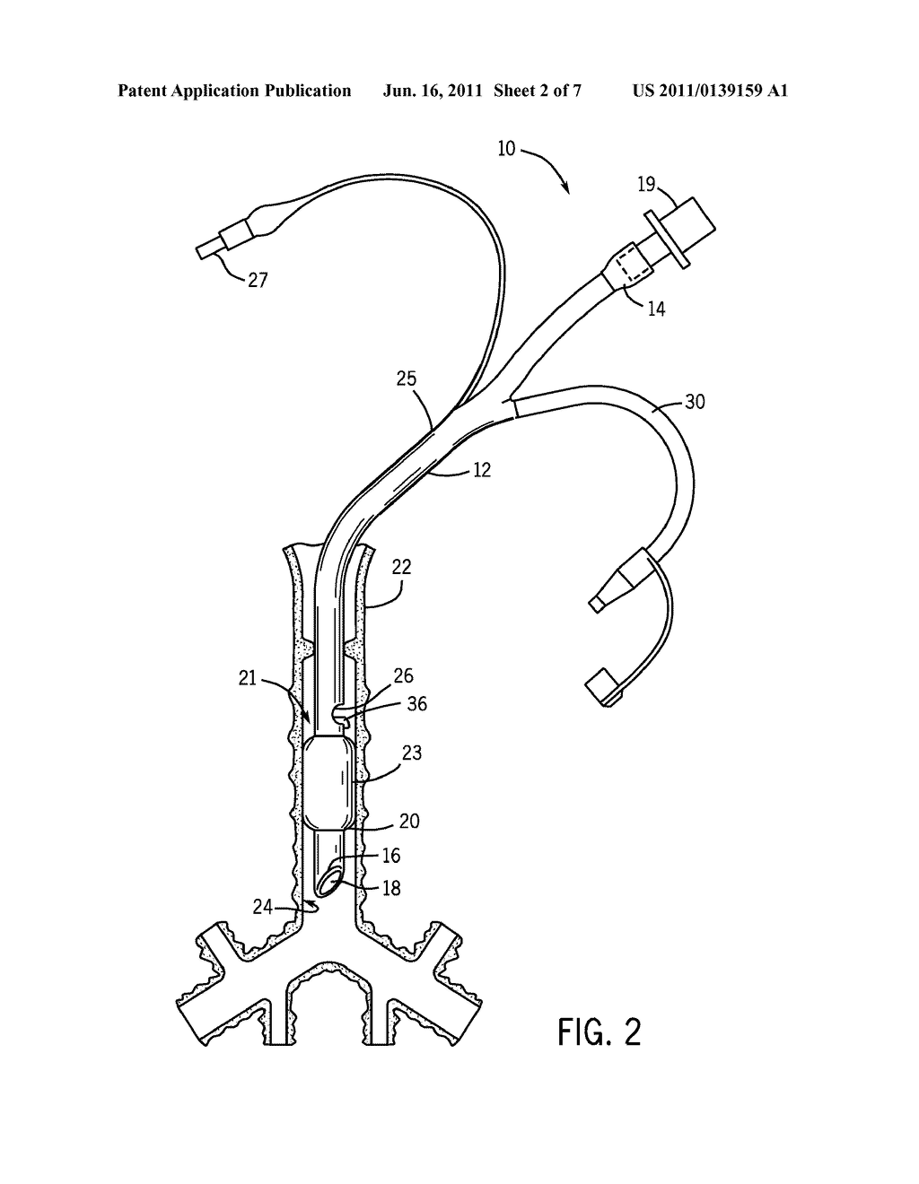 METHOD AND APPARATUS FOR PREVENTING OCCLUSION OF A TRACHEAL TUBE SUCTION     LUMEN - diagram, schematic, and image 03