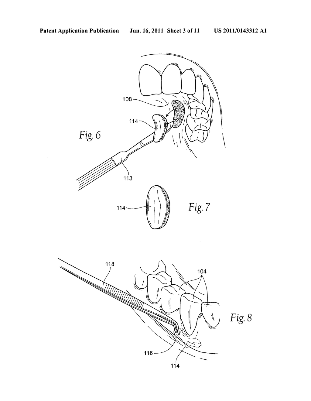 Compositions, assemblies, and methods applied during or after a dental     procedure to ameliorate fluid loss and/or promote healing, using a     hydrophilic polymer sponge structure such as chitosan - diagram, schematic, and image 04
