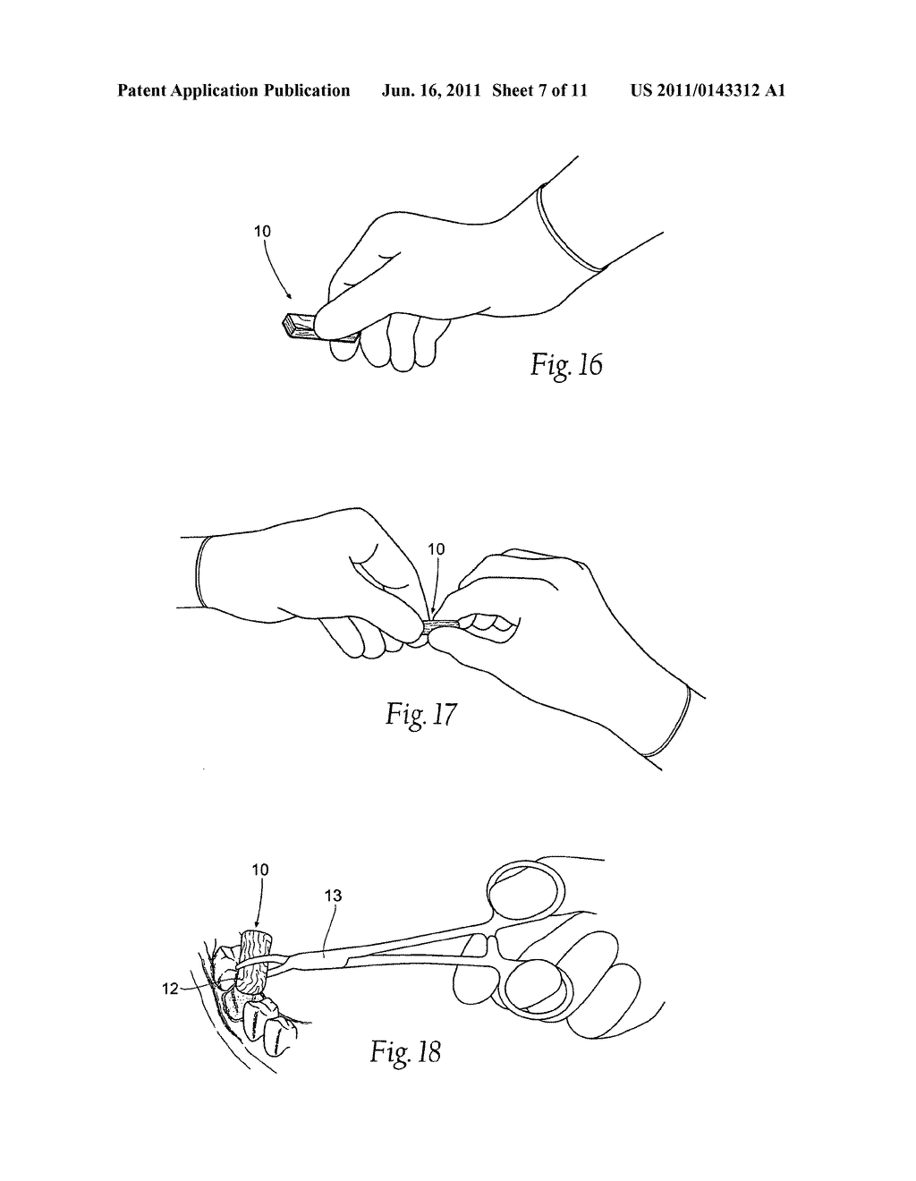 Compositions, assemblies, and methods applied during or after a dental     procedure to ameliorate fluid loss and/or promote healing, using a     hydrophilic polymer sponge structure such as chitosan - diagram, schematic, and image 08