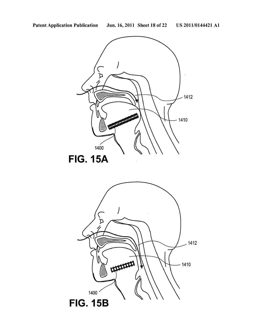 PARTIALLY ERODABLE SYSTEMS FOR TREATMENT OF OBSTRUCTIVE SLEEP APNEA - diagram, schematic, and image 19