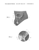 Median Lobe Retraction Apparatus and Method diagram and image