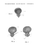 Median Lobe Retraction Apparatus and Method diagram and image