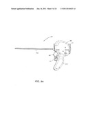 Median Lobe Retraction Apparatus and Method diagram and image