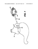 METHOD OF IMPLANTING A FLUID INJECTION PORT diagram and image