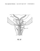 Apparatus and Method for Manipulating or Retracting Tissue and Anatomical     Structure diagram and image