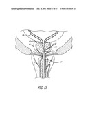 Apparatus and Method for Manipulating or Retracting Tissue and Anatomical     Structure diagram and image