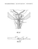 Apparatus and Method for Manipulating or Retracting Tissue and Anatomical     Structure diagram and image