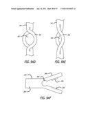 Apparatus and Method for Manipulating or Retracting Tissue and Anatomical     Structure diagram and image