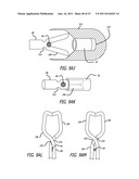 Apparatus and Method for Manipulating or Retracting Tissue and Anatomical     Structure diagram and image