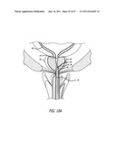 Apparatus and Method for Manipulating or Retracting Tissue and Anatomical     Structure diagram and image