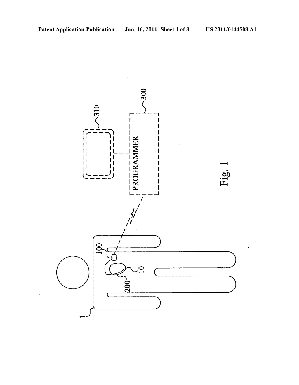 METHOD AND DEVICE FOR MONITORING ACUTE DECOMPENSATED HEART FAILURE - diagram, schematic, and image 02