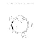 MEMS DEVICE AND METHOD FOR DELIVERY OF THERAPEUTIC AGENTS diagram and image