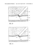 TISSUE CLOSURE DEVICES, DEVICE AND SYSTEMS FOR DELIVERY, KITS AND METHODS     THEREFOR diagram and image