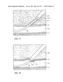 TISSUE CLOSURE DEVICES, DEVICE AND SYSTEMS FOR DELIVERY, KITS AND METHODS     THEREFOR diagram and image